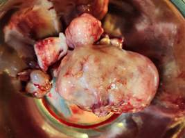 Fibroid Uterus