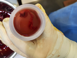 Lap salpinjectomy I ruptured ectopic