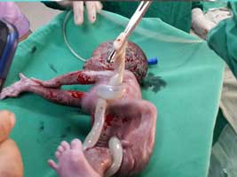 True knot in umbilical cord