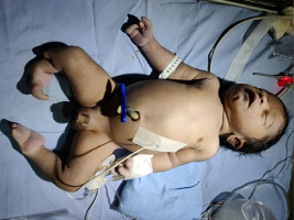Baby with multiple congenital anomalies