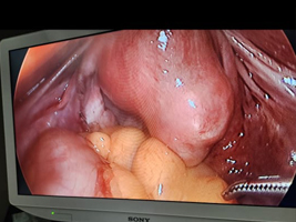 Fibroid