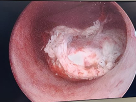 Hysteroscopic endometrial polyp resection